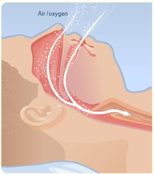 03072016 sleep apnea body 1