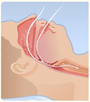 03072016 sleep apnea body 2