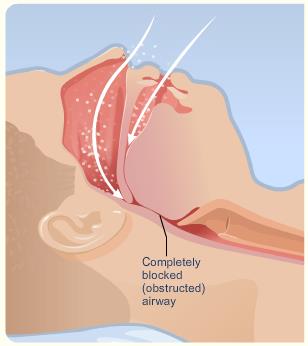 03072016 sleep apnea body 3